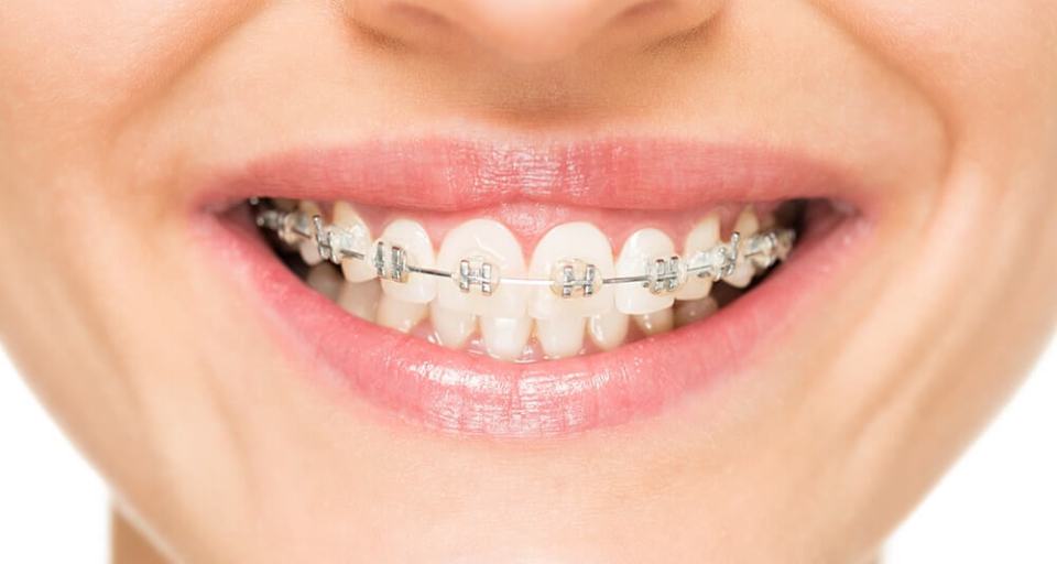 Why Are Braces So Expensive And How Can I Afford Them?