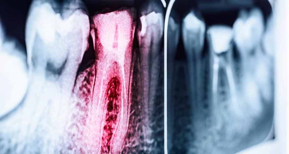 How to Save Money on Root Canals and Endodontics